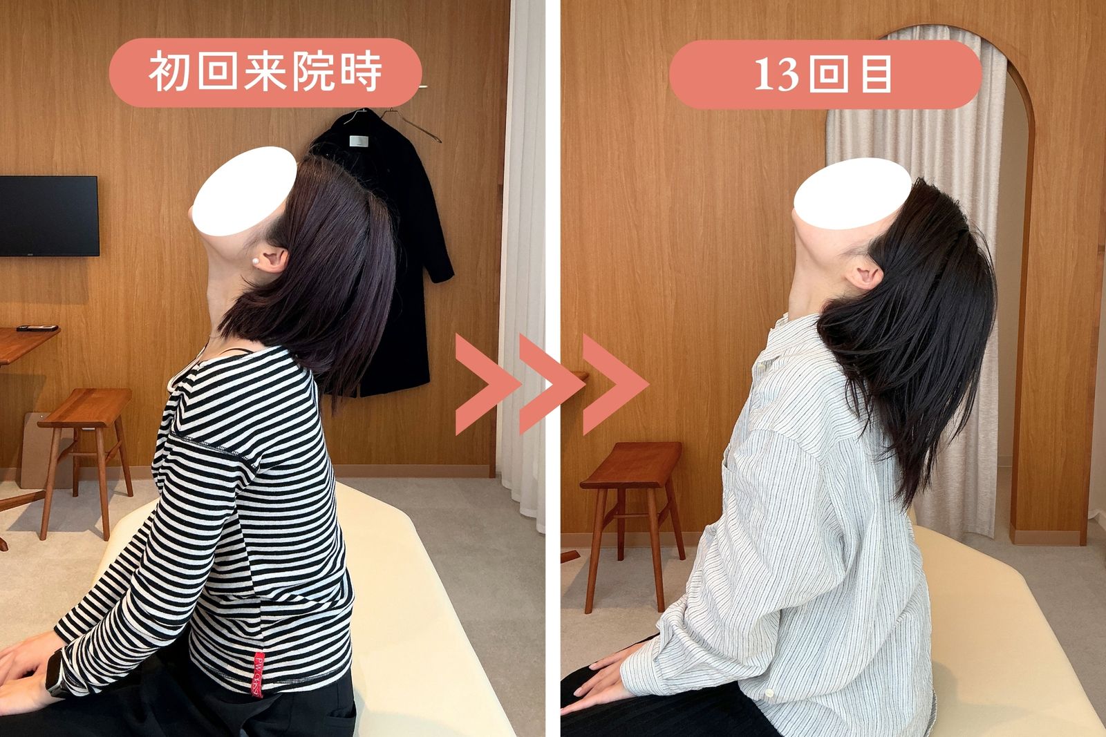 首を後ろに倒す動きの比較。初回来院時と13回目
