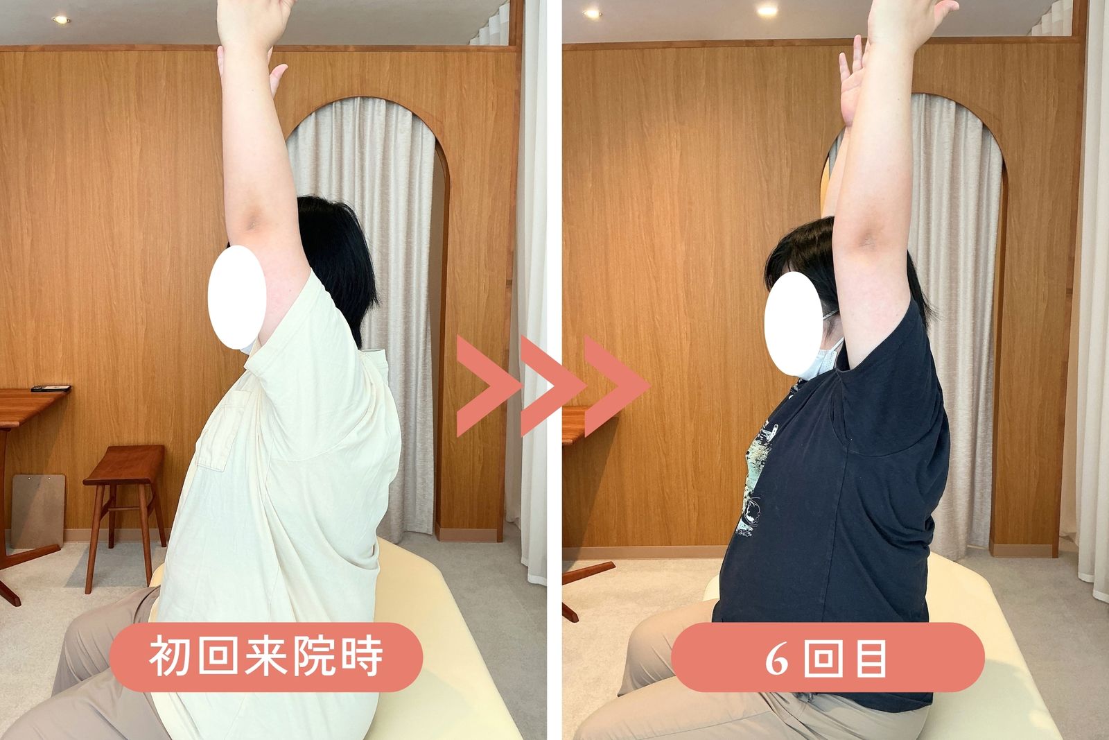 腕を真上に上げる動きの比較。初回来院時と6回目